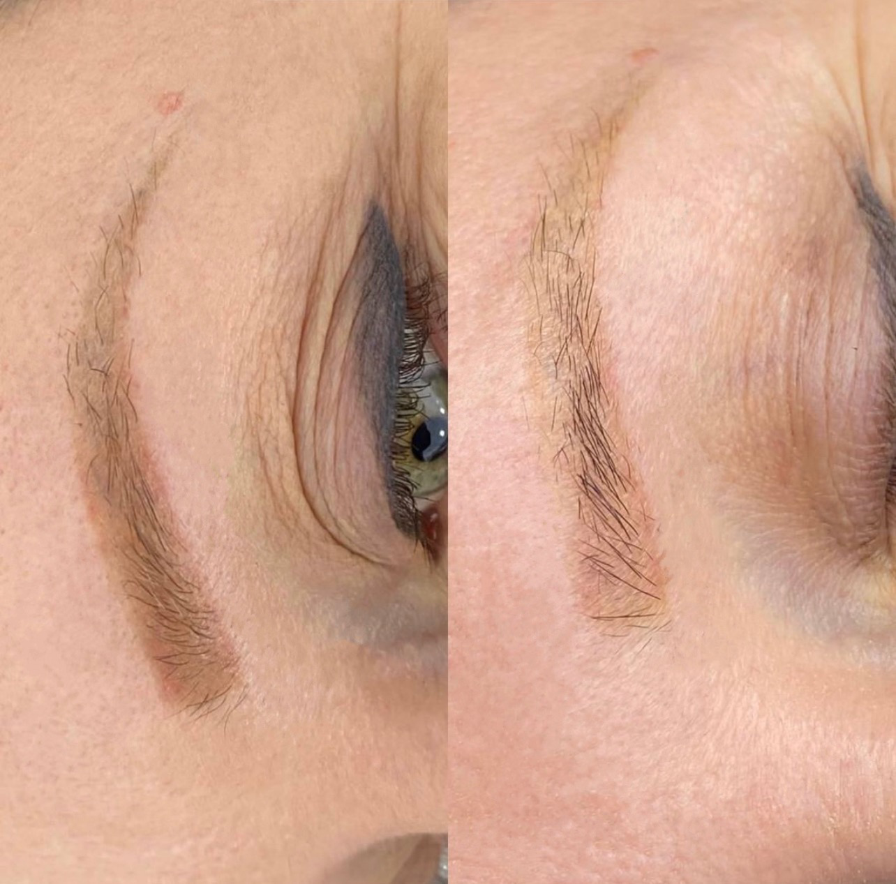 Eyebrows tattoo removal