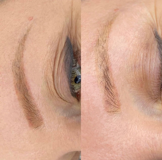 Eyebrows tattoo removal